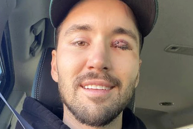 Jeff Wittek Eye Accident Leaked Video Scandalize On Twitter, Reddit, Tumblr...