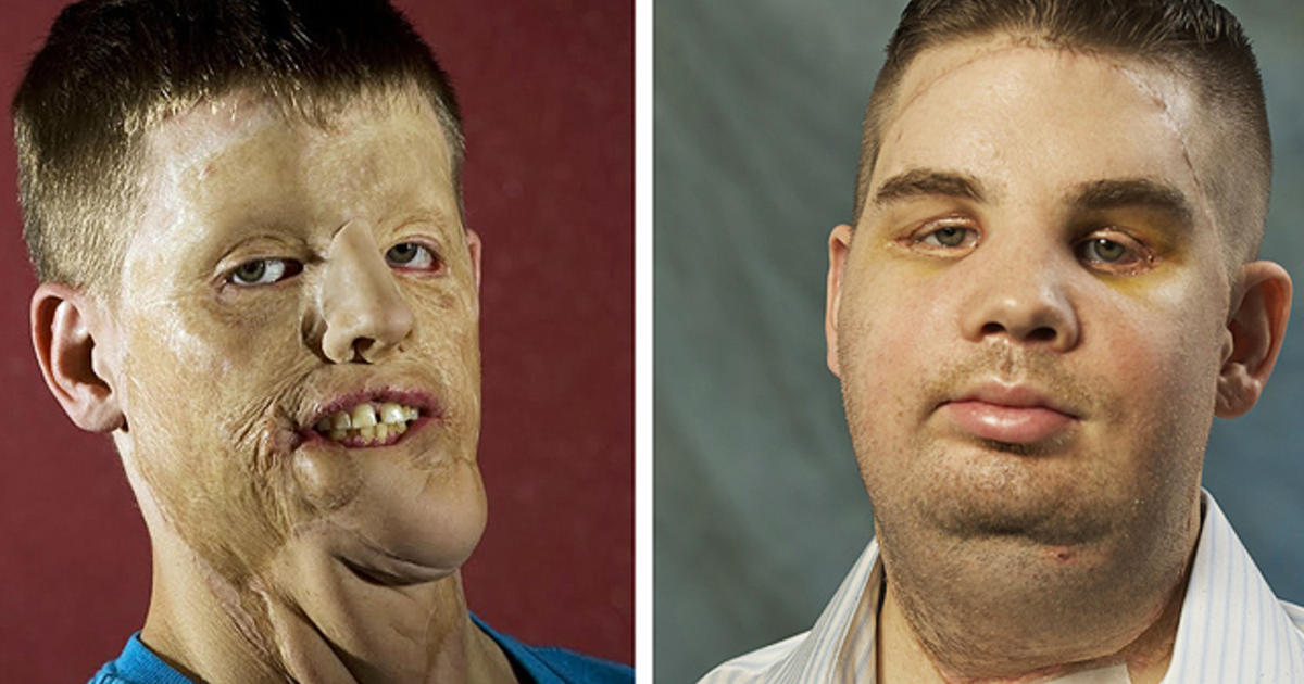 Mitch Hunter ‘Before And After’ Transplant Pictures