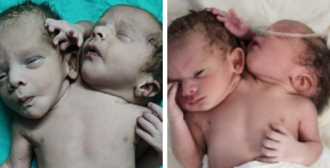 WATCH  Baby Born With Two Heads   Three Arms In Ratlam  Madhya Pradesh Videos   Photos Went Viral On Twitter  - 33