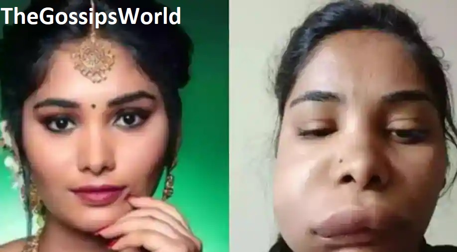 Swathi Sathish Face  What Happened To Kannada Actress Swathi Sathish  Root Canal Surgery Goes Wrong  Before   After Pics  - 32