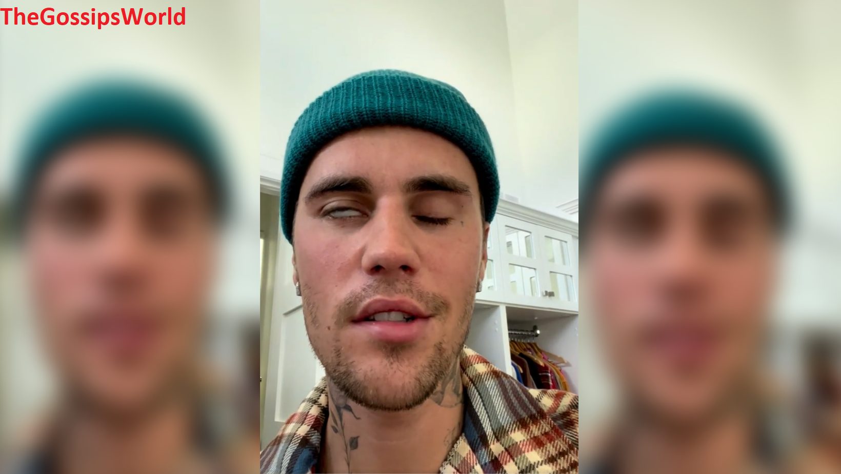 What happened to Justin Bieber's face?