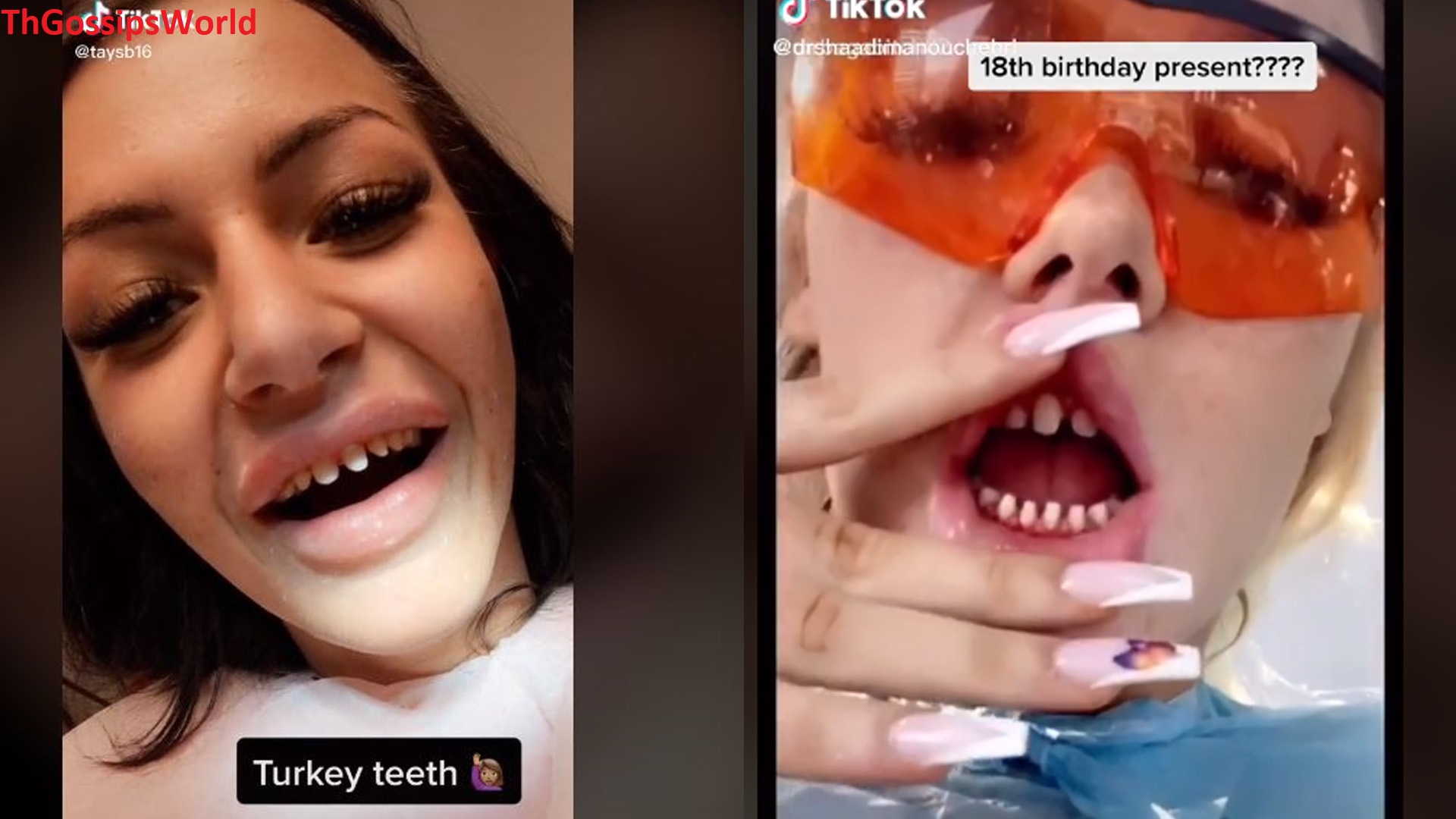 TIKTOK  What Is Turkey Teeth TikTok Trend  Why Is It So Dangerous  Everything You Need To Know  - 97